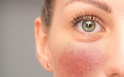 Las pieles con rojeces se pueden aliviar