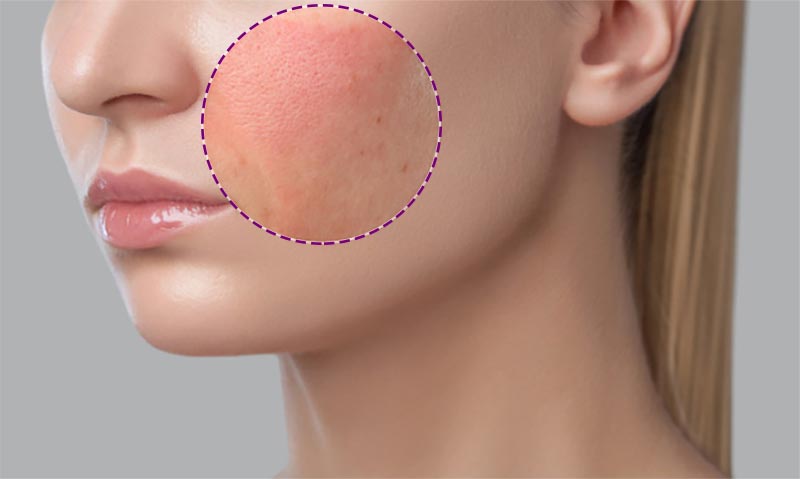 Mejilla de mujer con circulo pintado en zona de mejilla con rosácea.